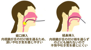 経口と経鼻挿入の違い